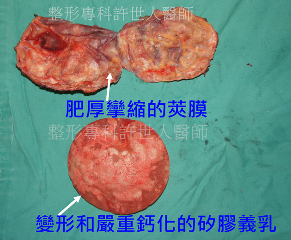 拯救矽膠假體隆乳失敗的新方法—SIEF假體脂肪置換隆乳術 