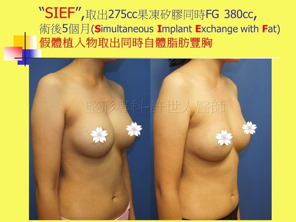 拯救矽膠假體隆乳失敗的新方法—SIEF假體脂肪置換隆乳術