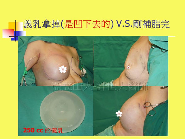 拯救矽膠假體隆乳失敗的新方法—SIEF假體脂肪置換隆乳術 