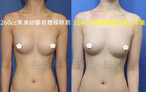 拯救矽膠假體隆乳失敗的新方法—SIEF假體脂肪置換隆乳術