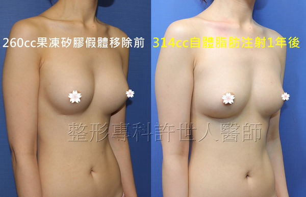 拯救矽膠假體隆乳失敗的新方法—SIEF假體脂肪置換隆乳術
