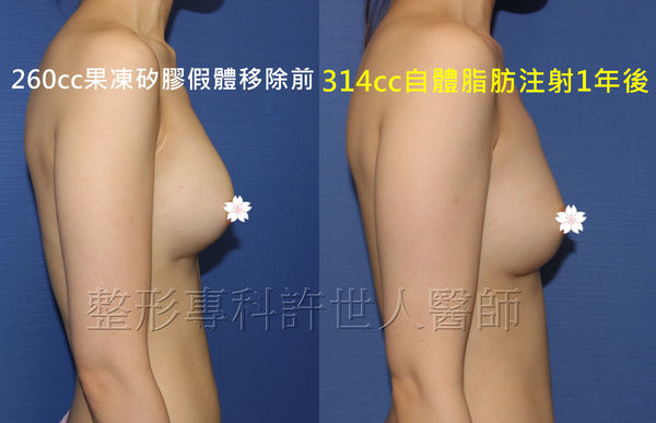 拯救矽膠假體隆乳失敗的新方法—SIEF假體脂肪置換隆乳術