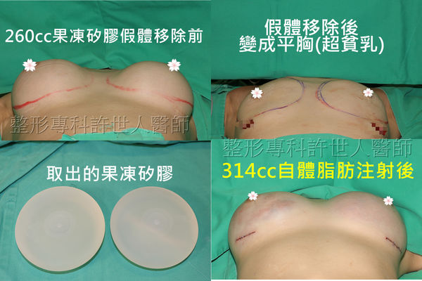 拯救矽膠假體隆乳失敗的新方法—SIEF假體脂肪置換隆乳術