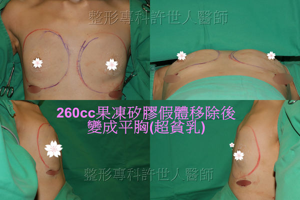 拯救矽膠假體隆乳失敗的新方法—SIEF假體脂肪置換隆乳術