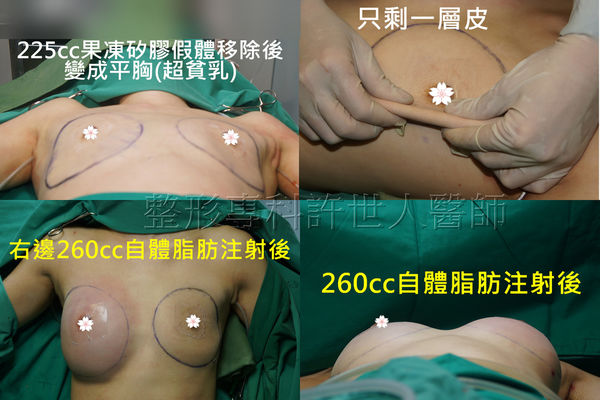 拯救矽膠假體隆乳失敗的新方法—SIEF假體脂肪置換隆乳術 