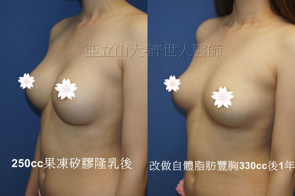拯救矽膠假體隆乳失敗的新方法—SIEF假體脂肪置換隆乳術