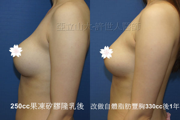 拯救矽膠假體隆乳失敗的新方法—SIEF假體脂肪置換隆乳術