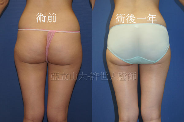 拯救矽膠假體隆乳失敗的新方法—SIEF假體脂肪置換隆乳術