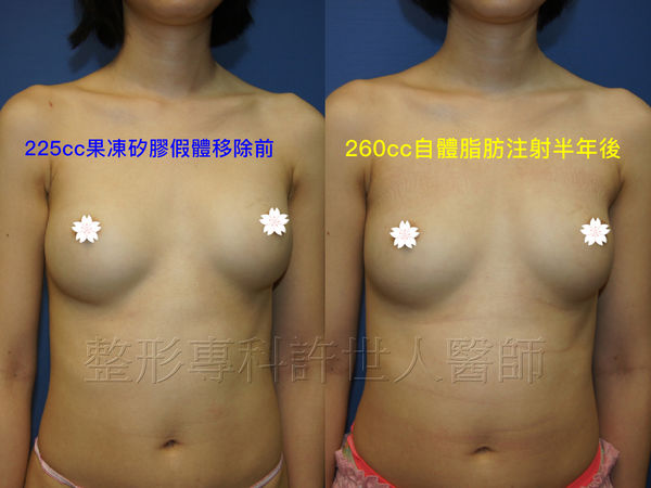 拯救矽膠假體隆乳失敗的新方法—SIEF假體脂肪置換隆乳術