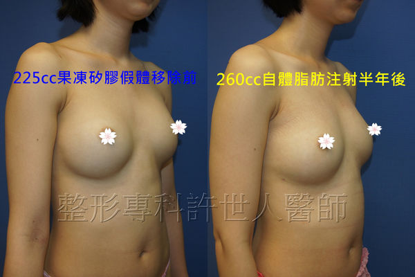 拯救矽膠假體隆乳失敗的新方法—SIEF假體脂肪置換隆乳術