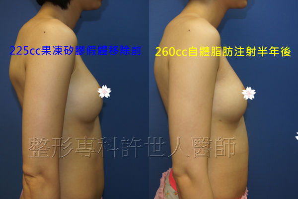 拯救矽膠假體隆乳失敗的新方法—SIEF假體脂肪置換隆乳術