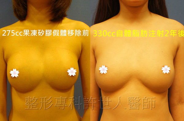 拯救矽膠假體隆乳失敗的新方法—SIEF假體脂肪置換隆乳術