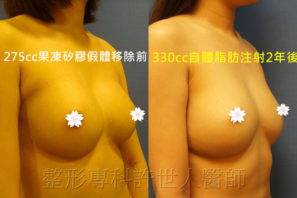 拯救矽膠假體隆乳失敗的新方法—SIEF假體脂肪置換隆乳術