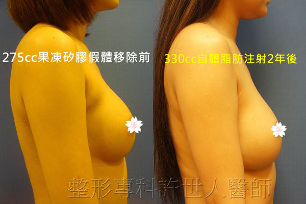 拯救矽膠假體隆乳失敗的新方法—SIEF假體脂肪置換隆乳術