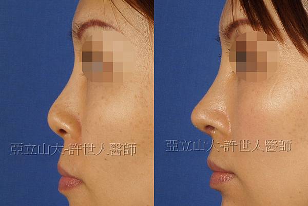 二次隆鼻,韓式結構式隆鼻,二次隆鼻案例