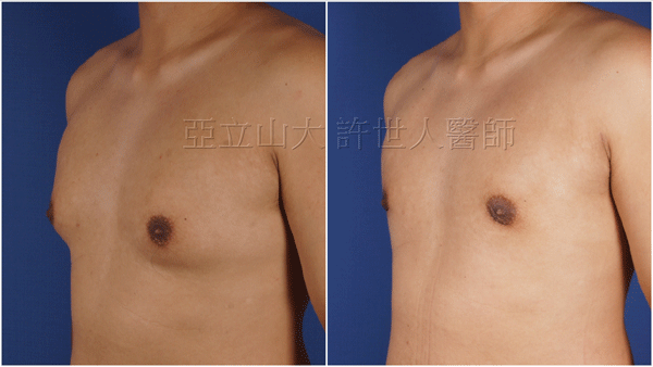 男性女乳症手術