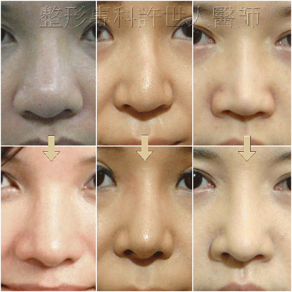 三段結構式隆鼻重修案例