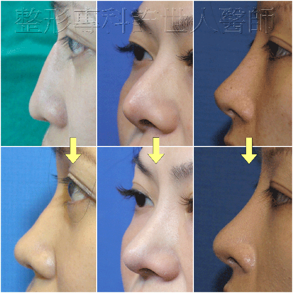 三段結構式隆鼻重修案例