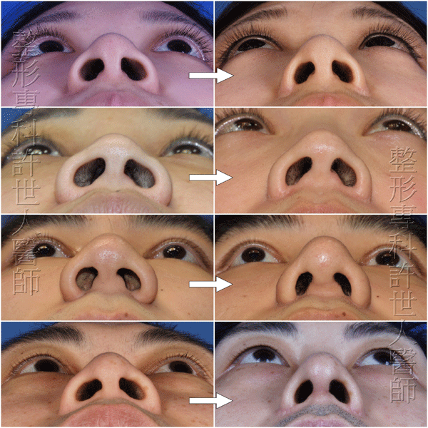 縮鼻翼手術案例