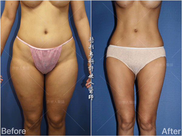 羅丹轉世? <全方位抽脂達人的誕生> 5 威塑VASER抽脂體雕案例分享