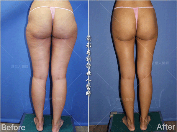 羅丹轉世? <全方位抽脂達人的誕生> 8 威塑VASER抽脂體雕案例分享