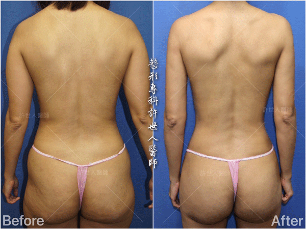 羅丹轉世? <全方位抽脂達人的誕生> 7 威塑VASER抽脂體雕案例分享