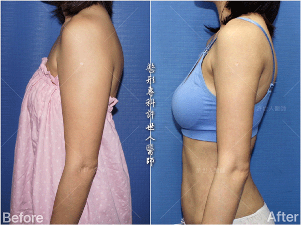 羅丹轉世? <全方位抽脂達人的誕生> 10 威塑VASER抽脂體雕案例分享