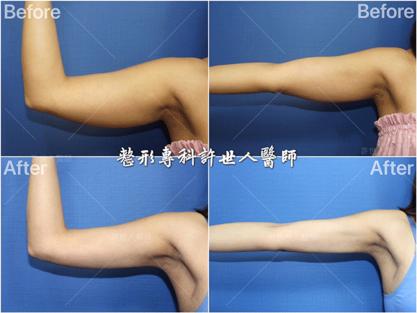 羅丹轉世? <全方位抽脂達人的誕生> 11 威塑VASER抽脂體雕案例分享