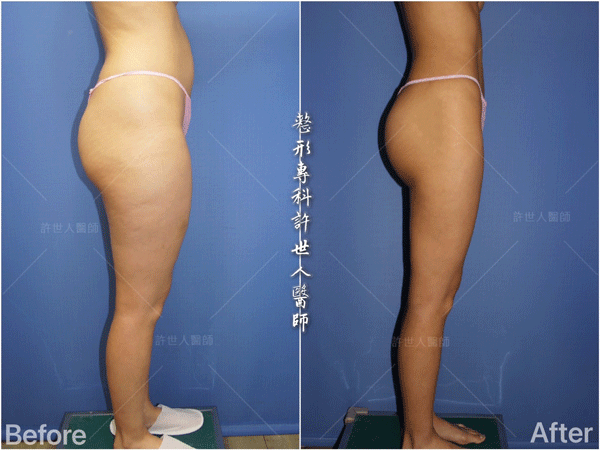 羅丹轉世? <全方位抽脂達人的誕生> 9 威塑VASER抽脂體雕案例分享