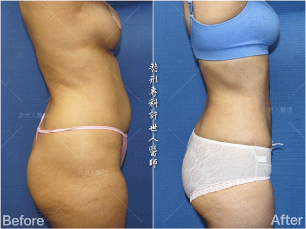 羅丹轉世? <全方位抽脂達人的誕生> 6 威塑VASER抽脂體雕案例分享