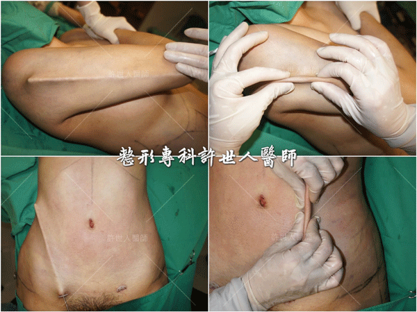 羅丹轉世? <全方位抽脂達人的誕生> 12 威塑VASER抽脂體雕案例分享