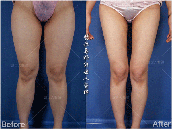 羅丹轉世? <全方位抽脂達人的誕生> 54 威塑抽脂案例 – 大小腿馬鞍環抽