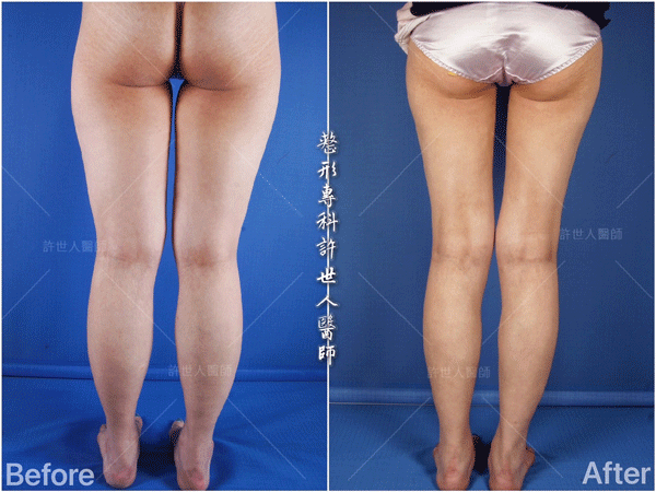 羅丹轉世? <全方位抽脂達人的誕生> 55 威塑抽脂案例 – 大小腿馬鞍環抽