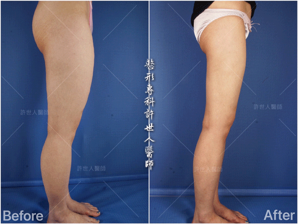 羅丹轉世? <全方位抽脂達人的誕生> 56 威塑抽脂案例 – 大小腿馬鞍環抽