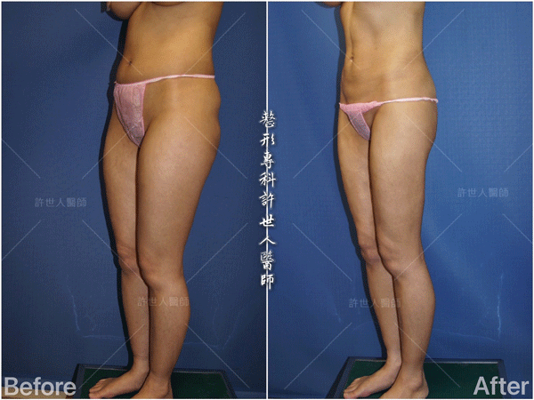 威塑抽脂案例 – 馬鞍大腿 腰腹臀