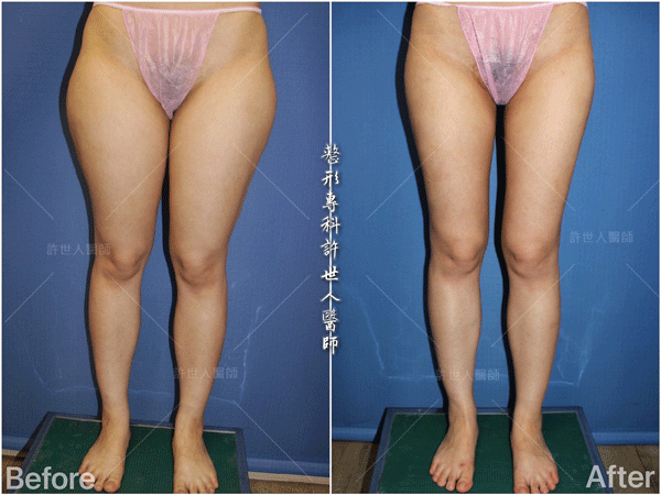 羅丹轉世? <全方位抽脂達人的誕生> 57 威塑抽脂案例 – 大腿馬鞍環抽