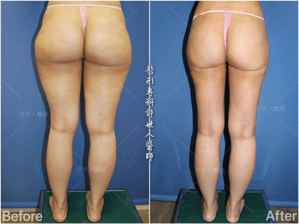 羅丹轉世? <全方位抽脂達人的誕生> 58 威塑抽脂案例 – 大腿馬鞍環抽
