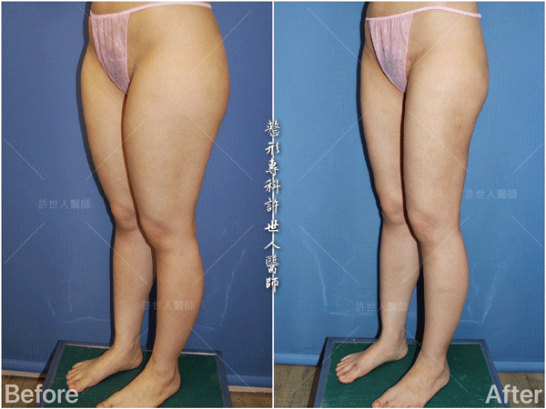 羅丹轉世? <全方位抽脂達人的誕生> 59 威塑抽脂案例 – 大腿馬鞍環抽