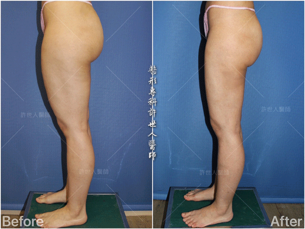 羅丹轉世? <全方位抽脂達人的誕生> 60 威塑抽脂案例 – 大腿馬鞍環抽