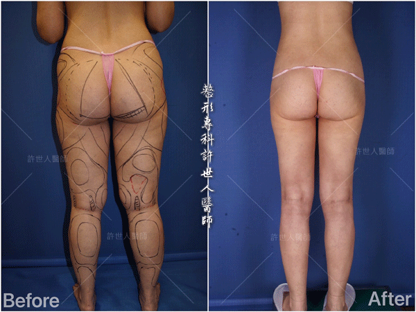 羅丹轉世? <全方位抽脂達人的誕生> 62 威塑VASER抽脂體雕案例 –全身多處+ 小腿