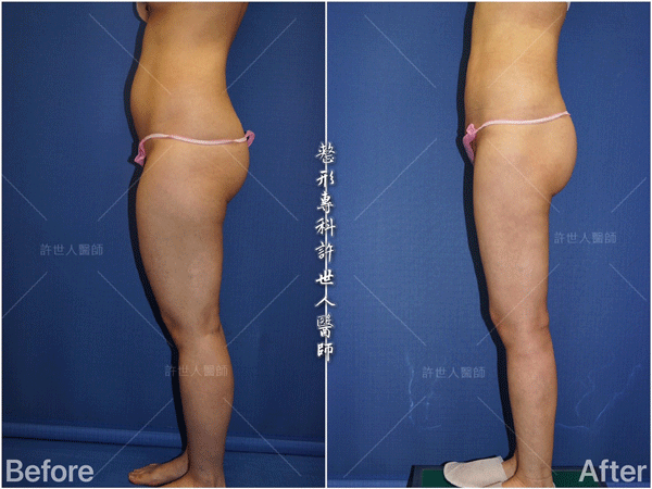 羅丹轉世? <全方位抽脂達人的誕生> 63 威塑VASER抽脂體雕案例 –全身多處+ 小腿