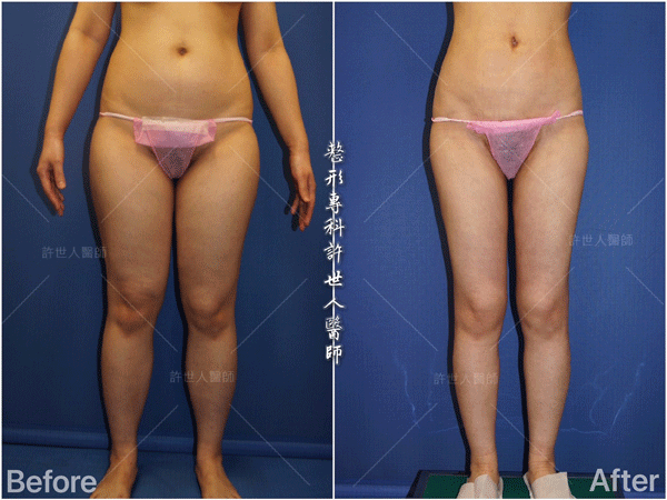 羅丹轉世? <全方位抽脂達人的誕生> 61 威塑VASER抽脂體雕案例 –全身多處+ 小腿