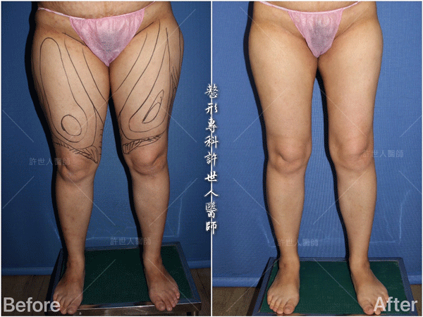 威塑VASER抽脂體雕案例 –全身多處