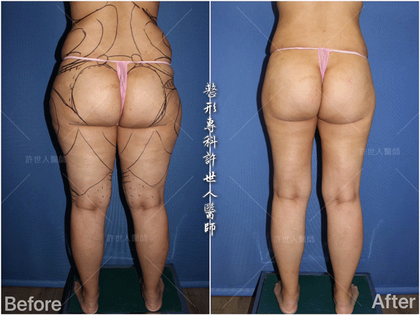 威塑VASER抽脂體雕案例 –全身多處