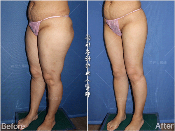 威塑VASER抽脂體雕案例 –全身多處