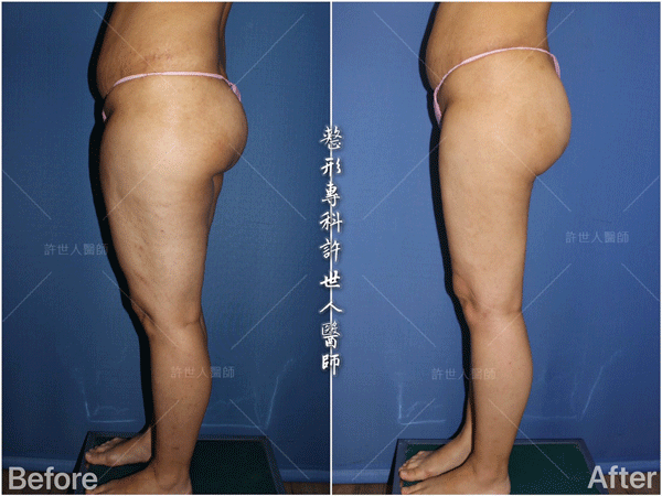 威塑VASER抽脂體雕案例 –全身多處環抽