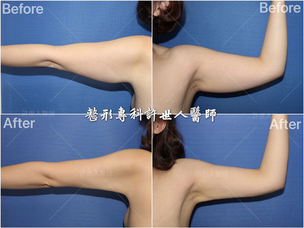 全身威塑VASER抽脂體雕+自體脂肪隆乳