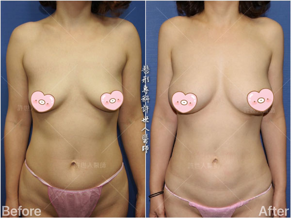 全身威塑VASER抽脂體雕+自體脂肪隆乳