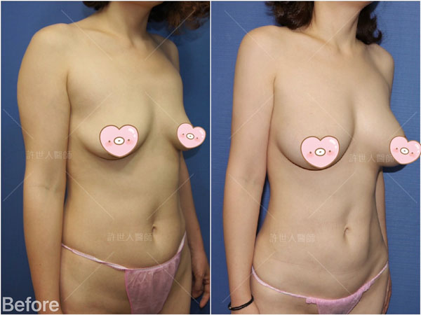 全身威塑VASER抽脂體雕+自體脂肪隆乳