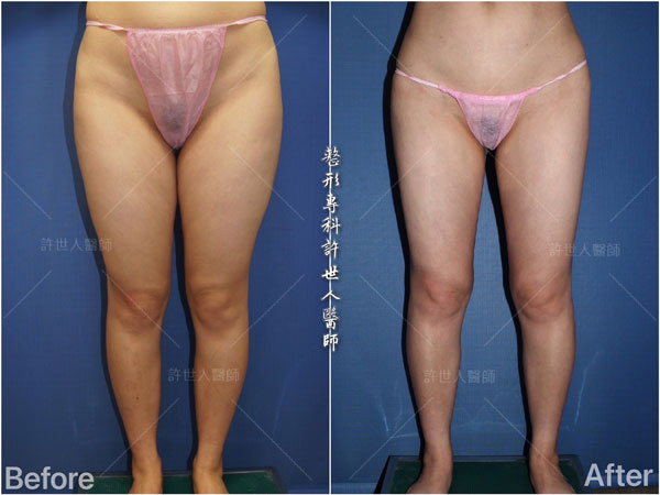 全身威塑VASER抽脂體雕+自體脂肪隆乳